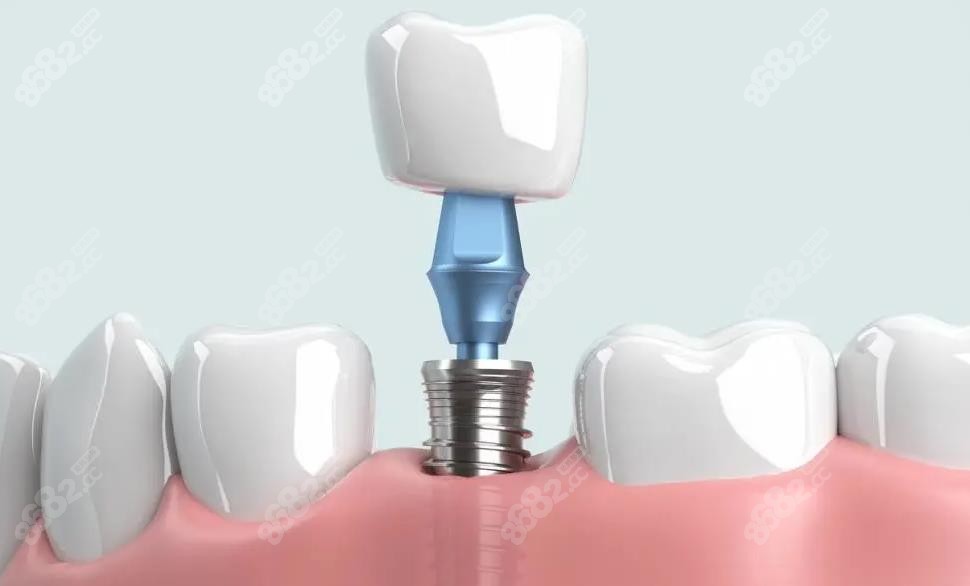 海口口腔医院种植牙多少钱