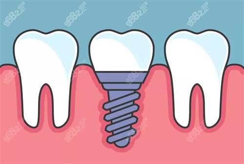 中諾口腔種植牙集采價格表一覽