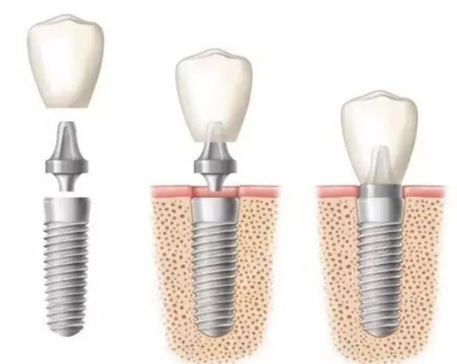 种植牙 种植牙