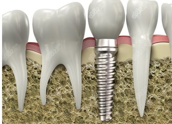 美國登士柏植體m.66ub.cn 美國登士柏植體m.66ub.cn