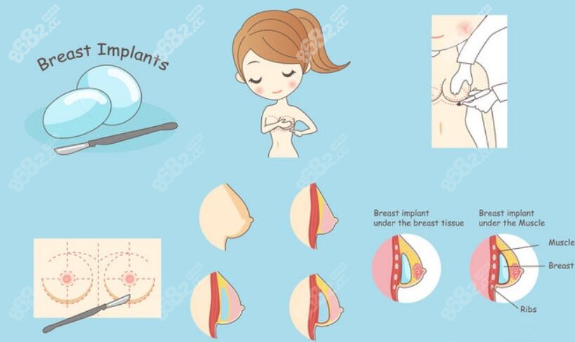 隆胸时假体的不同放置位置