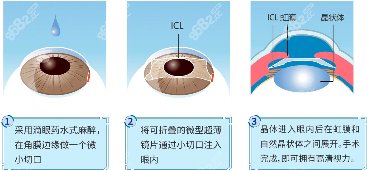 南京晶体植入近视眼手术价格一览表