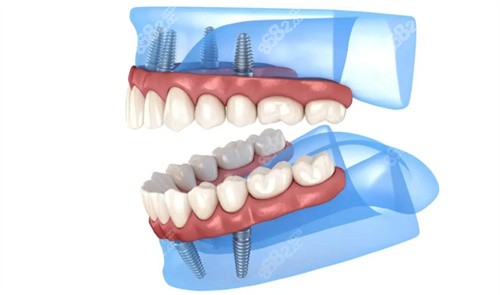 全口种植牙动画模拟图