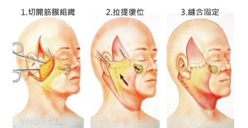 上海倪峰拉皮和上海张晓健拉皮价格对比