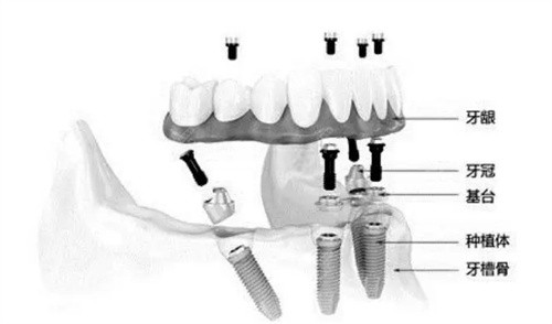 all-on-4种植牙模型图