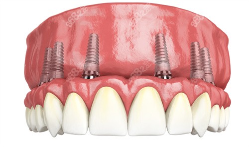 all-on-6半口种植牙动画图