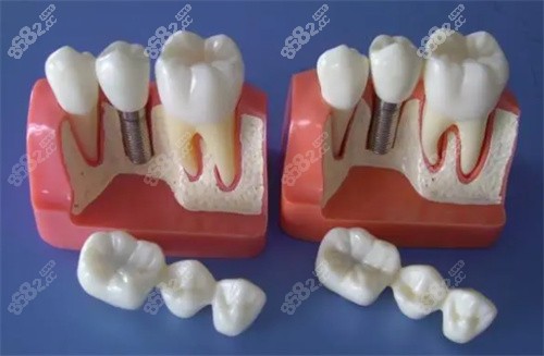 种植牙模型示例图