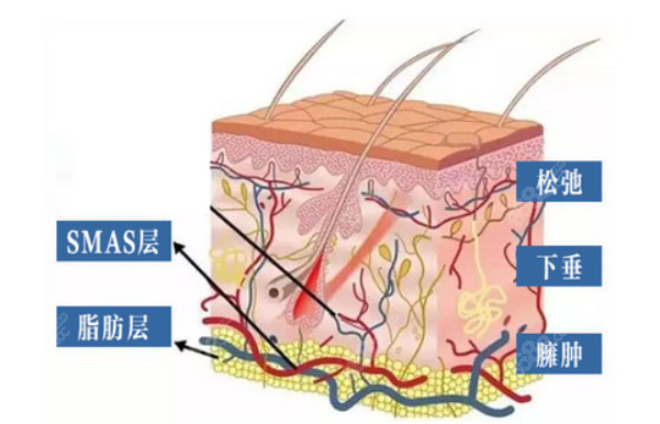 smas筋膜提升手术多久做一次比较好