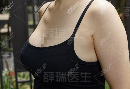 薛瑞隆胸真人实例