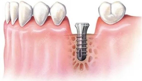 种植体植入示意图