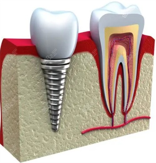 种植牙示意图