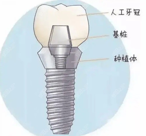 种植牙结构示意图