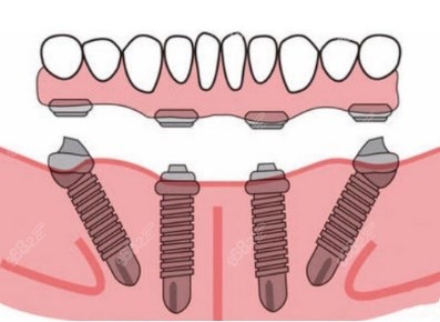 多颗种植牙