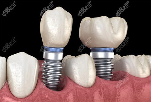 多颗种植牙动画展示图
