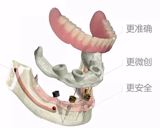 以色列种植牙安心可靠