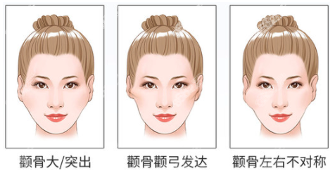 颌面磨骨手术优势和劣势是什么呢