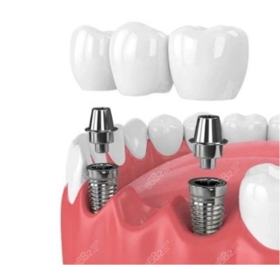 种植牙稳固性好