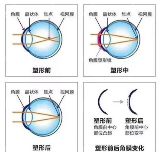 角膜塑形镜可以控制近视