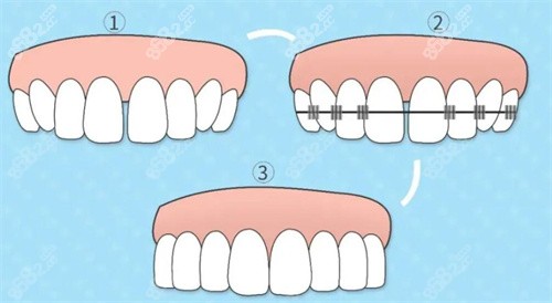 牙缝大矫正