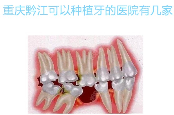 重庆黔江可以种植牙的医院有几家