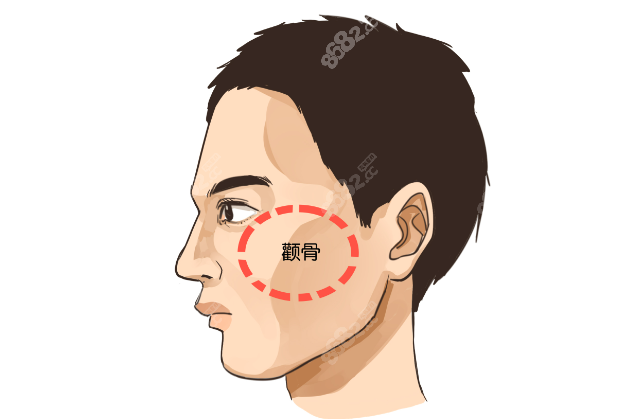 上海颧骨整形手术到底哪个医生好www.8682.cc