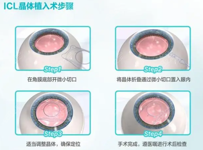 长沙博视眼科做icl晶体植入手术优势8682.cc