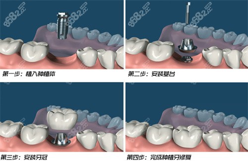 种植牙流程动画演示图