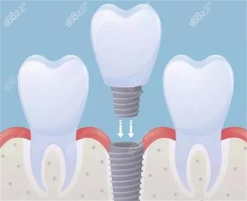 种植牙展示图