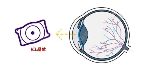 2023眼科白内障晶体植入收费价格一览