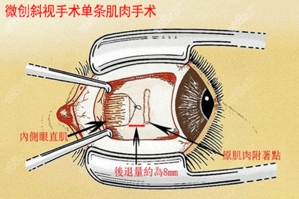 蓝周华厦眼科医院微创单条肌肉斜视矫正手术