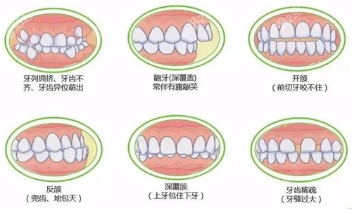 牙齿畸形的几种情况