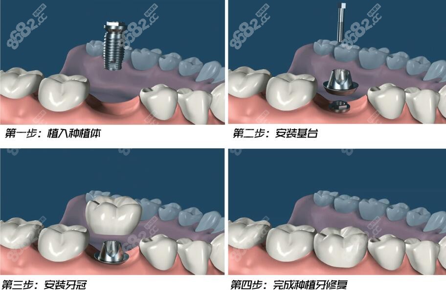 种植牙示意图