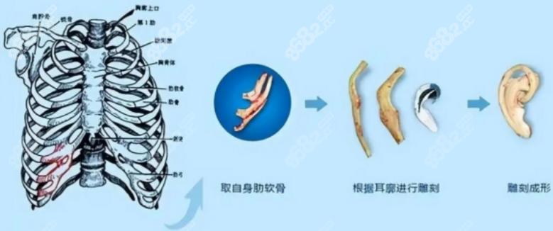 全包法肋软骨耳再造手术图片