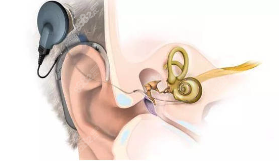 重庆徐铎人工耳蜗技术优势