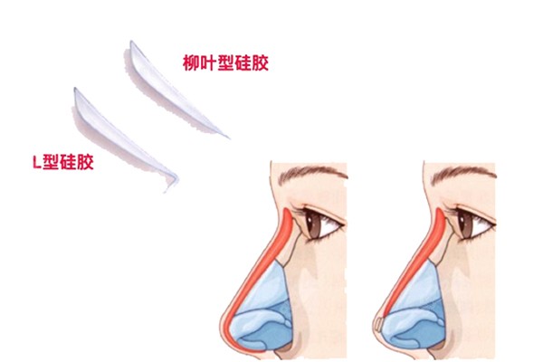 上海硅胶隆鼻大概多少钱