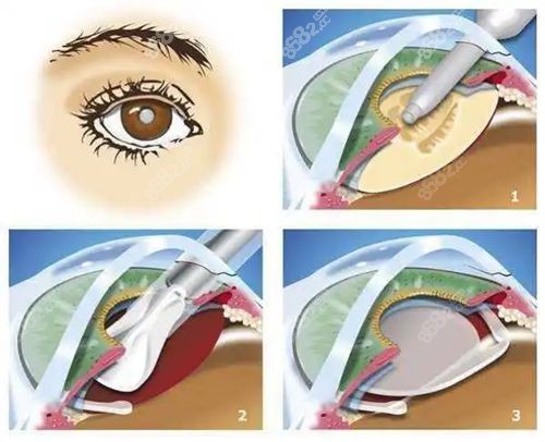 icl晶体植入的优缺点www.8682.cc