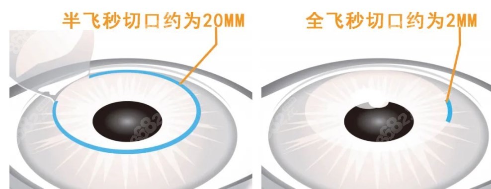 合肥近视眼激光手术价格