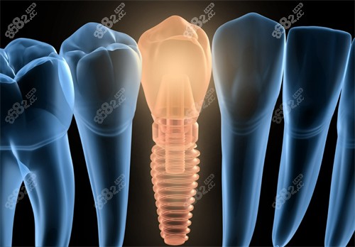 种植牙示意图