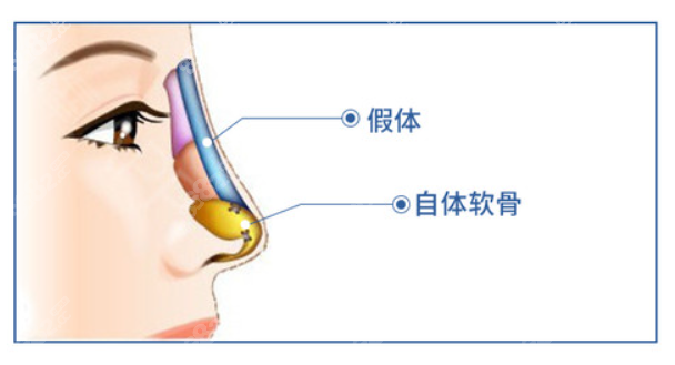 成都黄文做鼻综合的风格