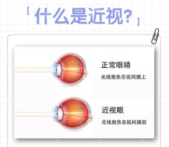 飞秒激光近视手术简介m.8682.cc