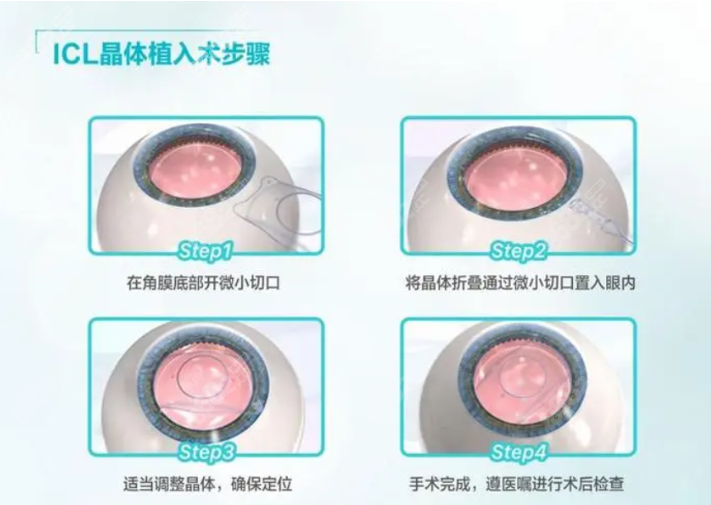 兰州华厦眼科医院prl晶体植入价格