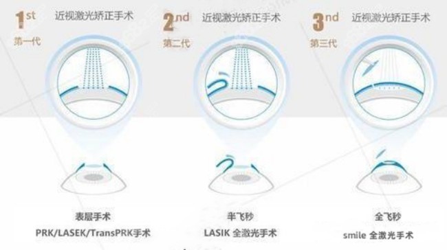 维视眼科医院做近视矫正的方式