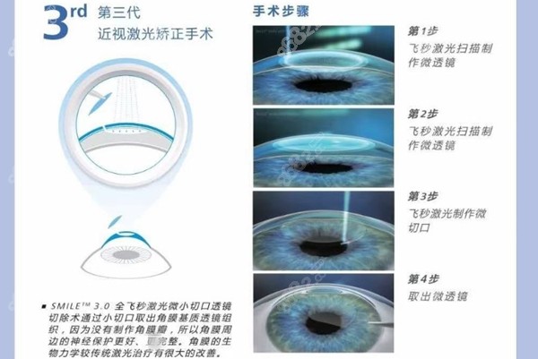 全飞秒手术过程www.8682.cc