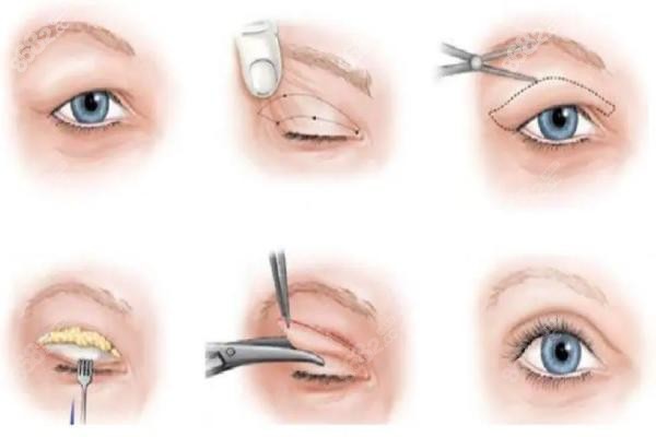 双眼皮整容手术流程