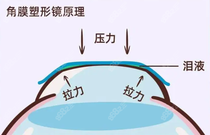 爱尔眼科角膜塑形镜的品牌和价格8682.cc