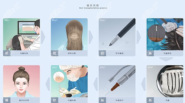 植发流程