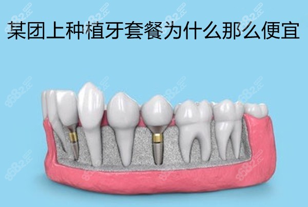 某团上种植牙套餐为什么那么便宜