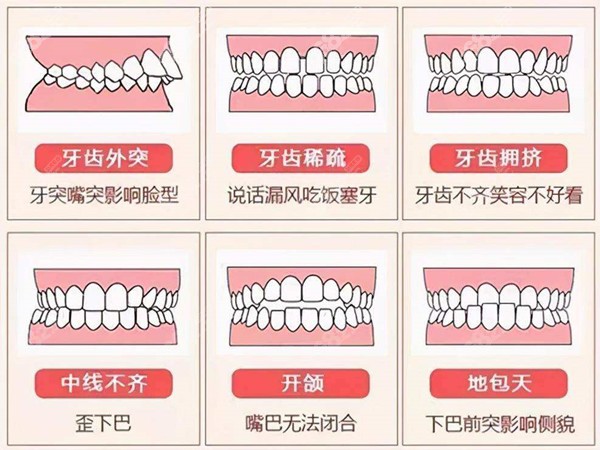 张琳医生可治疗的牙齿畸形类型