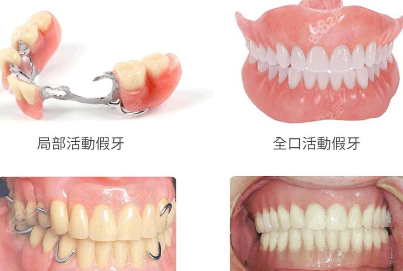 半口吸附性义齿收费价格不贵
