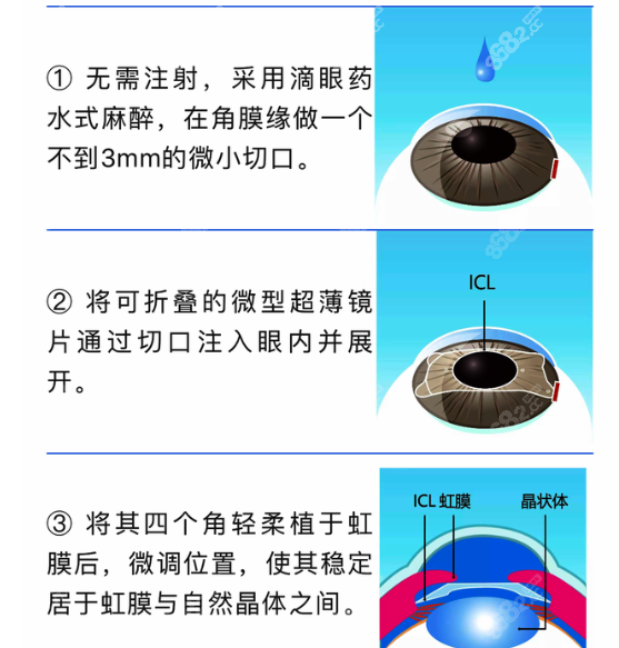 近视眼手术价格预算低于2万的人不适合icl晶体植入